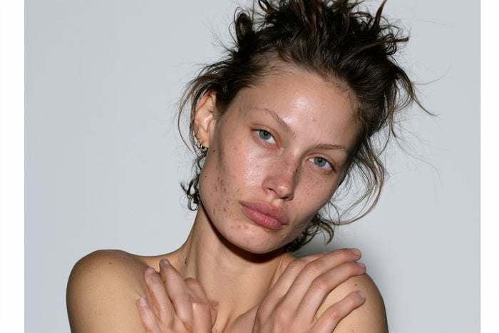 Pourquoi le CBD intéresse les peaux sujettes à l'acné | C-Derma by Céline